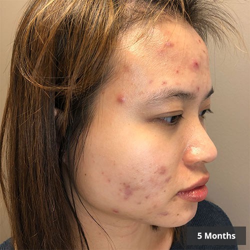 Vancouver Acne Treatment