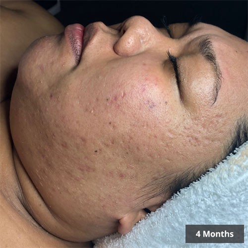 Dermaly - Acne Treatment Before and After Images Vancouver